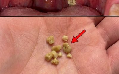 Tonsil Stones: Discover what they are, how they appear, and how to get rid of them forever.