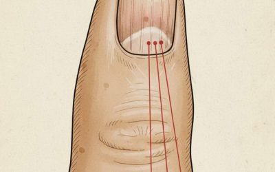 Als je strepen op je nagels hebt, betekent dat dat je kanker hebt… Lees meer