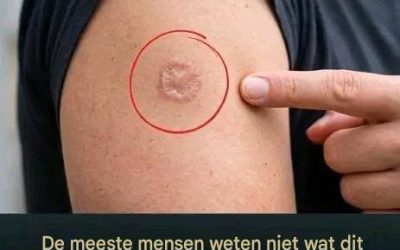 Een rond litteken op de arm: wat betekent dat?