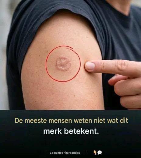 Een rond litteken op de arm: wat betekent dat?
