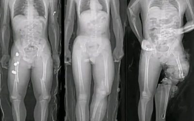 COVID-19. Wereldwijde waarschuwing. Gevaccineerde personen ontdekken een nieuwe vorm van kanker.