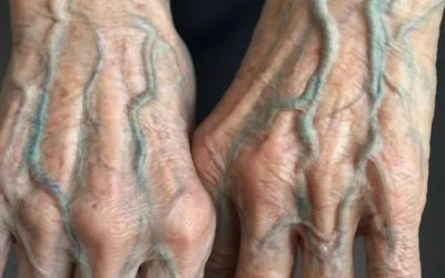 Als je aderen zichtbaar zijn op je hand, kan dat een teken zijn van… Bekijk meer.