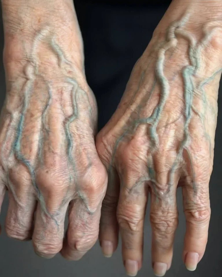 Als je aderen zichtbaar zijn op je hand, kan dat een teken zijn van… Bekijk meer.