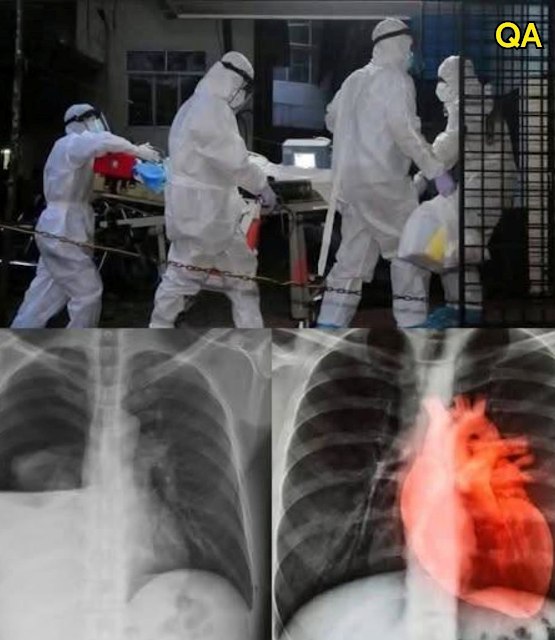 Waarschuwing: COVID-19-gevaccineerde kinderen kunnen besmet zijn… Lees meer