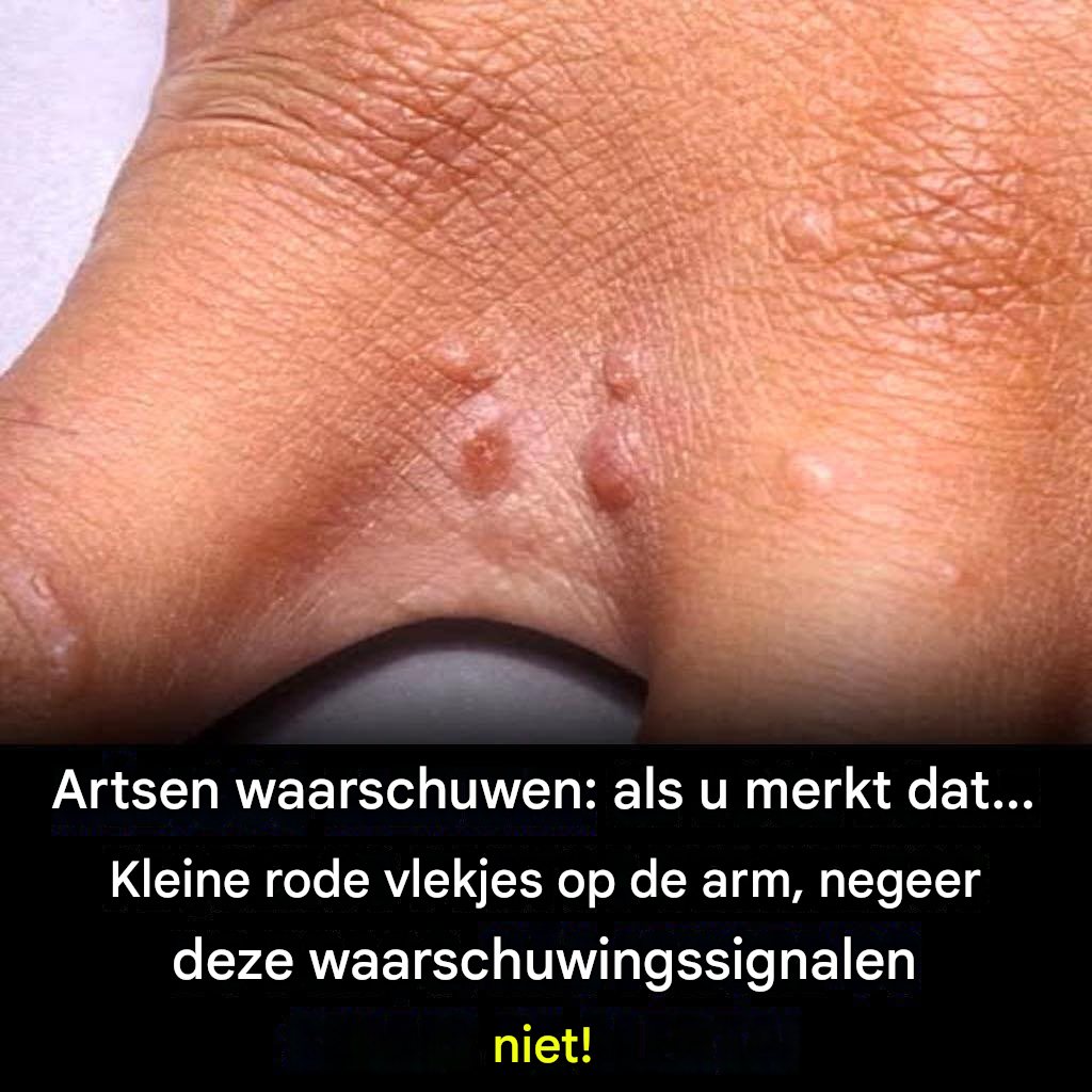 Rode vlekken op de huid en intense jeuk? Ontdek deze veelvoorkomende en vaak onbegrepen aandoening