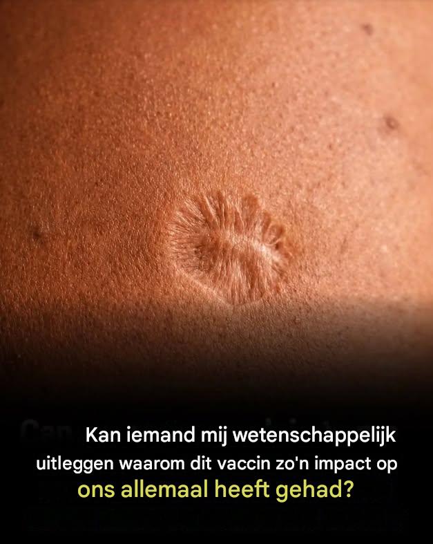 Waarom het pokkenvaccin een litteken achterliet