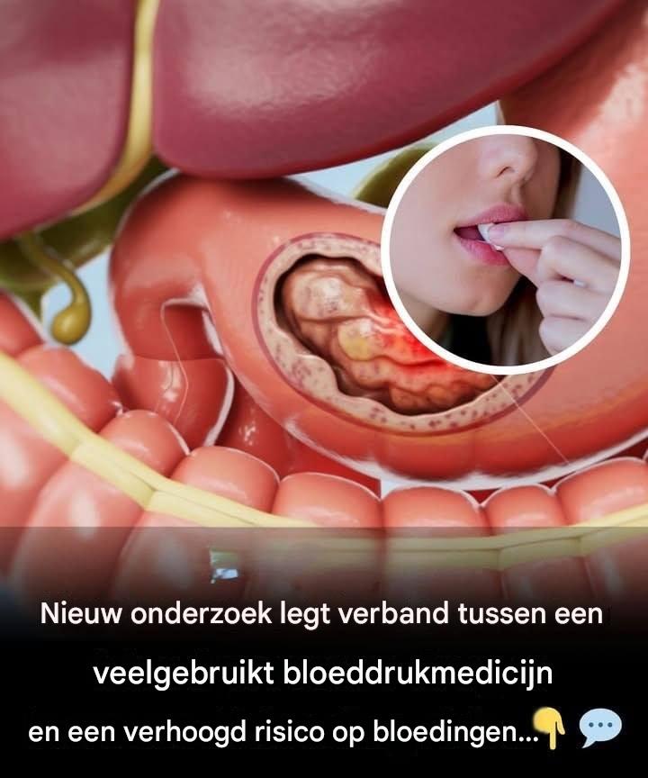 Nieuw onderzoek legt verband tussen veelgebruikt bloeddrukmedicijn en verhoogd bloedingsrisico.