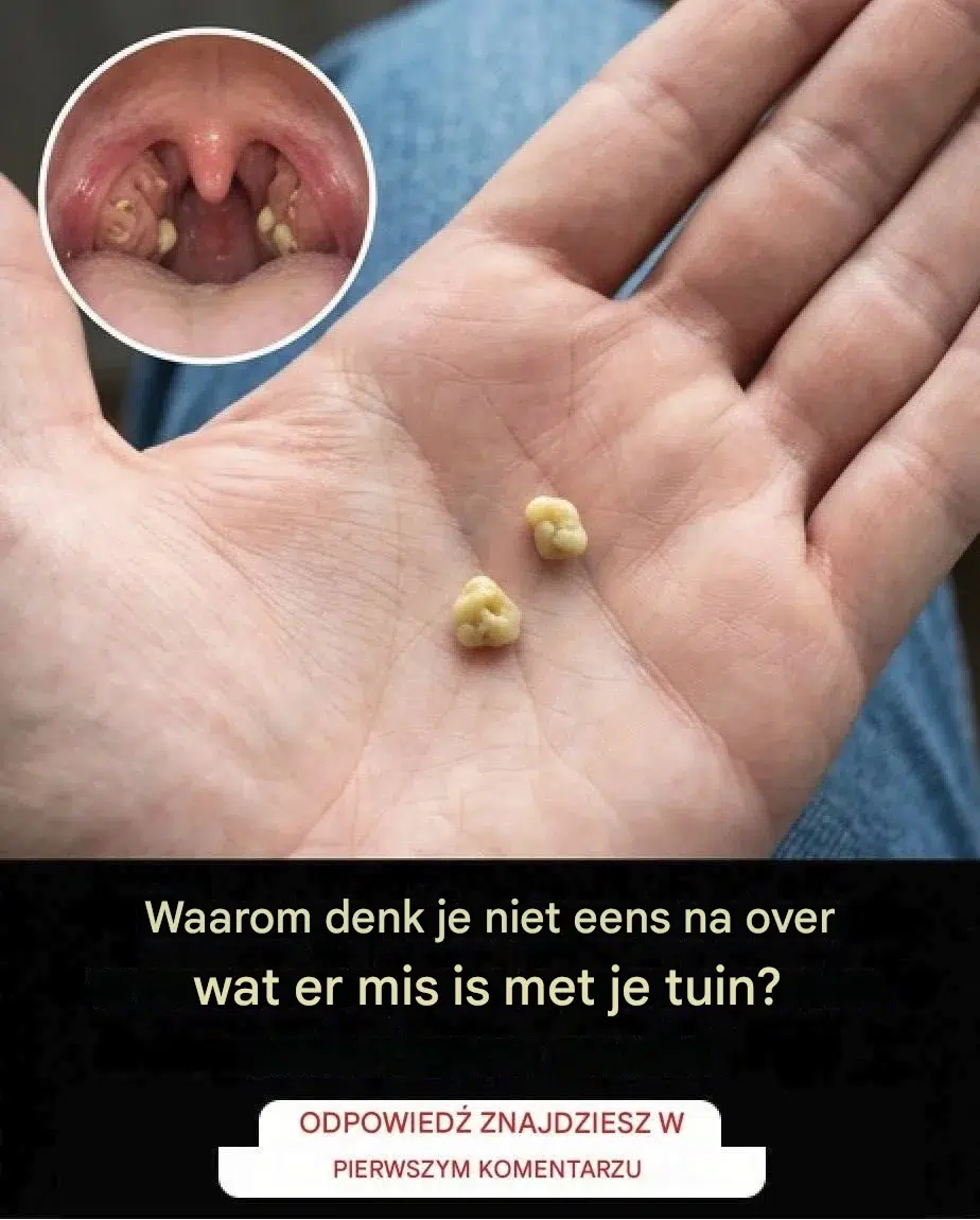 Galstenen: Wat zijn het en hoe kom je er vanaf?