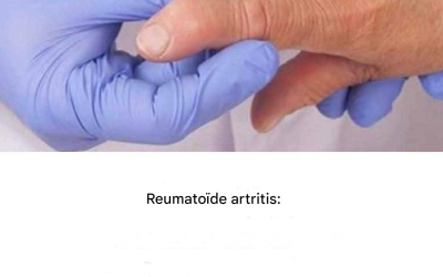 Leven met reumatoïde artritis: dagelijkse uitdagingen