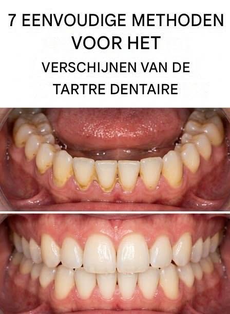 7 natuurlijke geheimen om afscheid te nemen van tandplak op je tanden