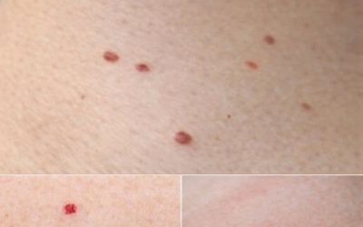 Rode puntjes op je huid: oorzaken en wat ze kunnen betekenen…