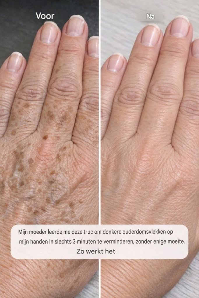 Mijn moeder heeft me deze truc geleerd om donkere ouderdomsvlekken op mijn handen in slechts 3 minuten en zonder enige moeite te verminderen. Zo werkt het: